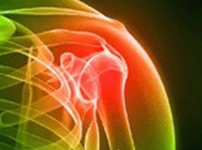 Τενοντίτιδα στον ώμο: Μια ύπουλη ασθένεια