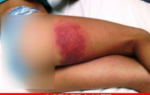 Μεγάλη ζημιά σε κοριτσάκι από θαλάσσια ανεμώνη