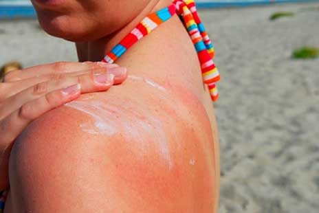 Τι να κάνουμε όταν μας ...κάψει ο ήλιος για τα καλά