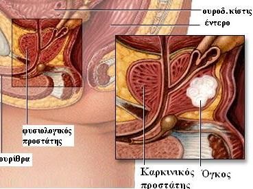Ομιλία για τον καρκίνο του προστάτη στο Αλιβέρι