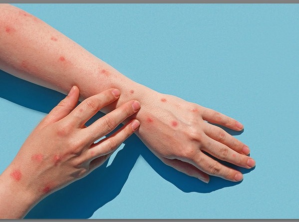 ΕΥΛΟΓΙΑ ΤΩΝ ΠΙΘΗΚΩΝ: Συνολικά 48 τα κρούσματα στην Ελλάδα