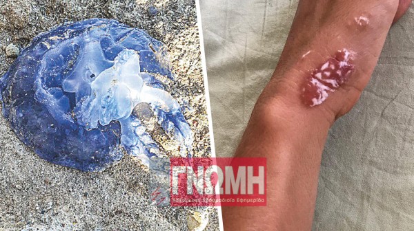 ΧΑΛΚΙΔΑ: Χαλάστρα στα μπάνια στη θάλασσα από τις μέδουσες