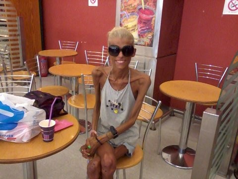 Δίνει μάχη με τη νευρική ανορεξία