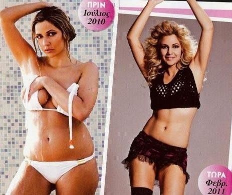 Ναι, έκανα λιποαναρρόφηση!