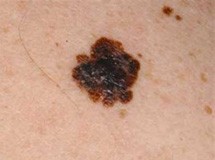 Δωρεάν εξετάσεις για την πρόληψη του μελανώματος