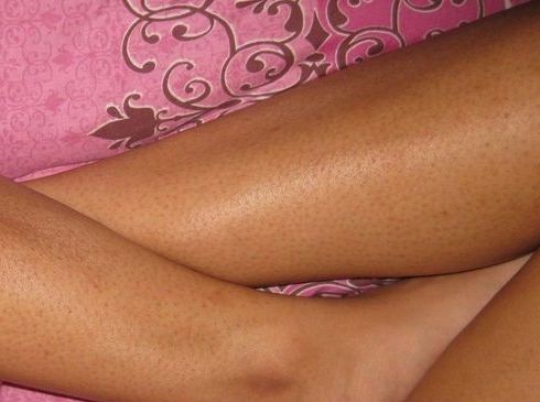 Διευρυμένοι πόροι στα πόδια σας μετά την αποτρίχωση;